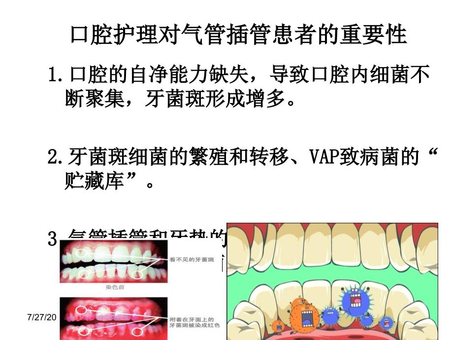 气管插管病人的口腔护理_第4页