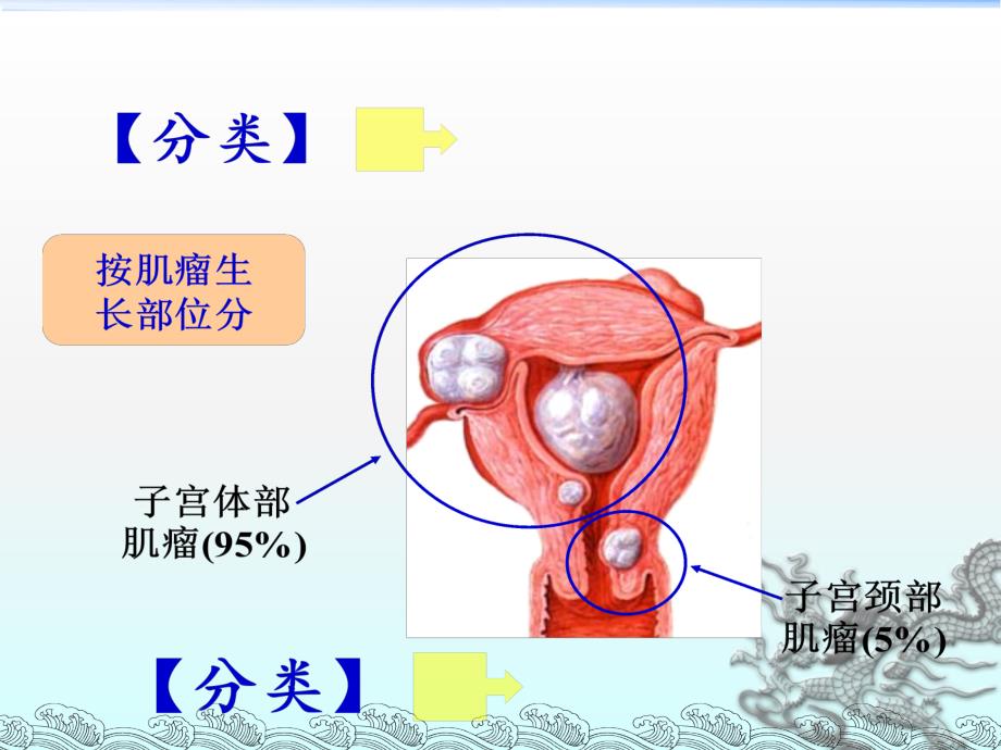 子宫肌瘤病人的术后护理_第4页