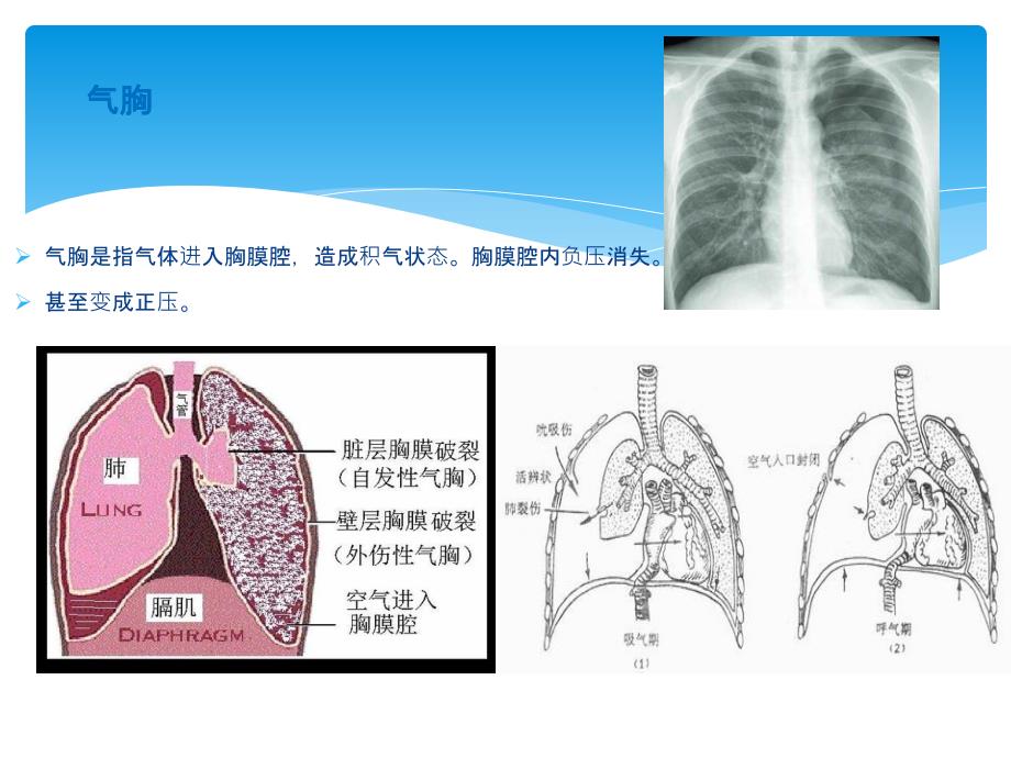 胸腔穿刺术实用讲解_第4页