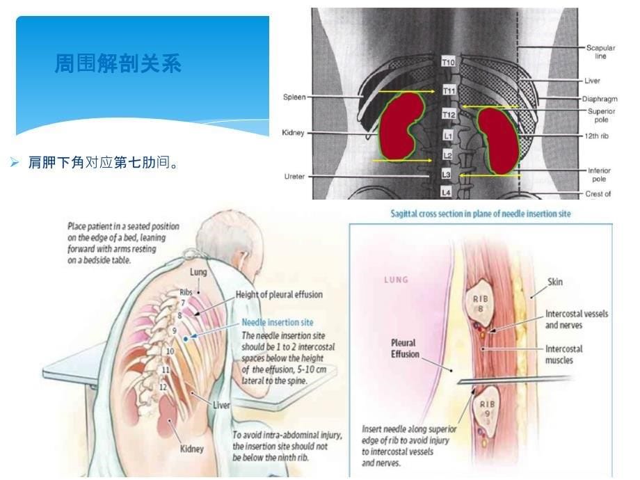 胸腔穿刺术实用讲解_第5页