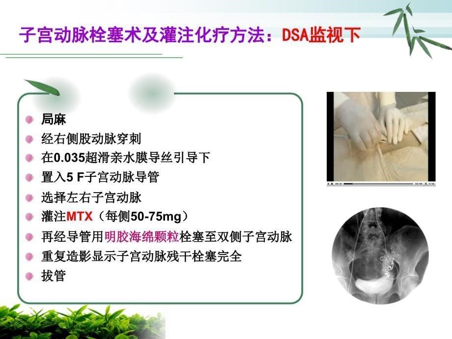 子宫切口妊娠的护理查房课件_第5页