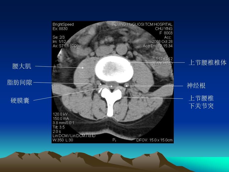 腰椎CT诊断大全新手实用_第3页