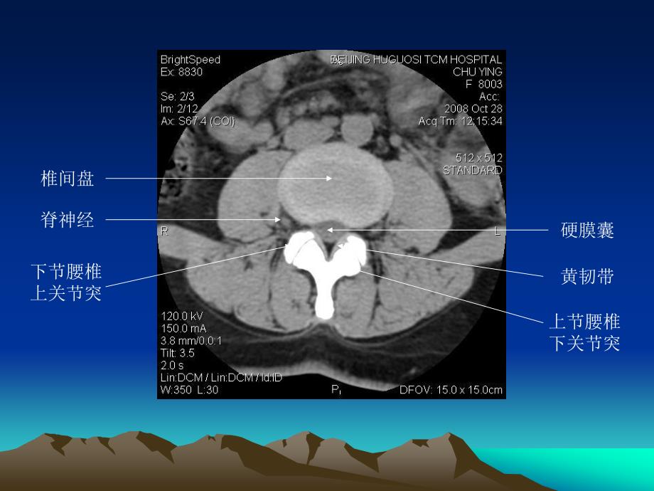 腰椎CT诊断大全新手实用_第4页