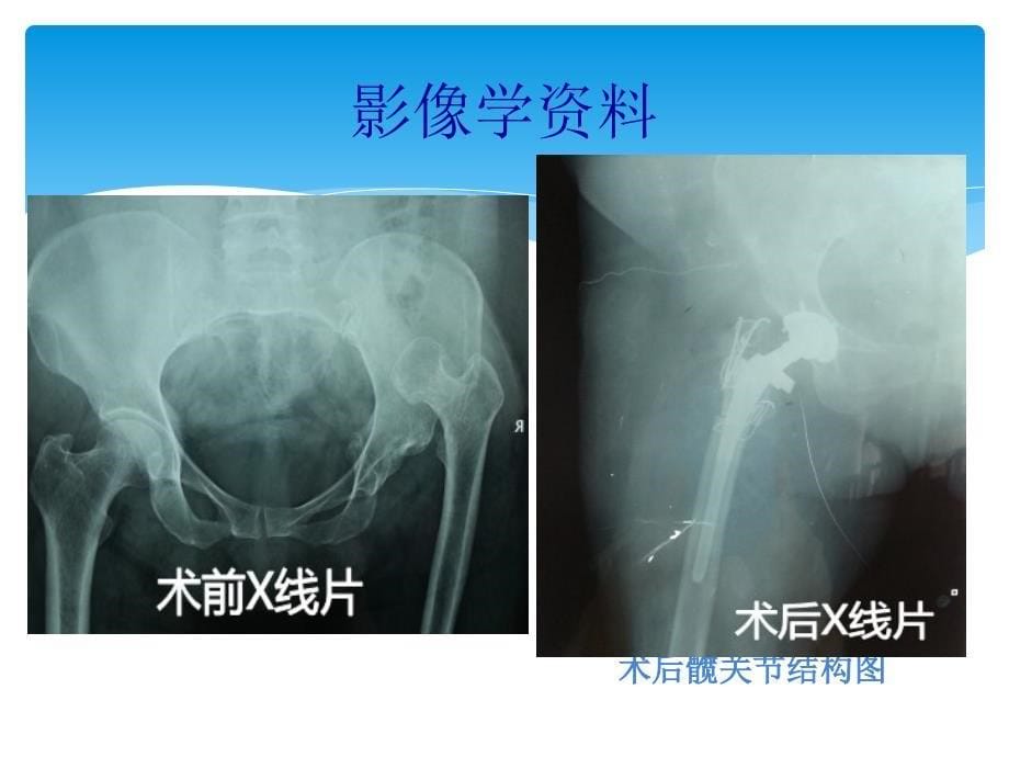 全髋关节置换术后护理查房._第5页