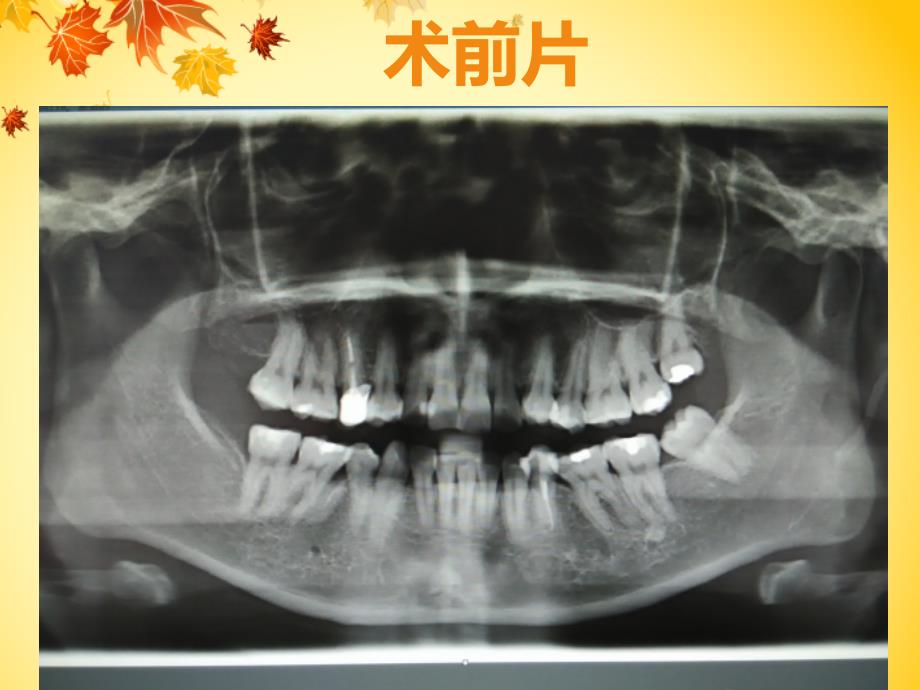 埋伏牙根的微创拔除课件_第2页