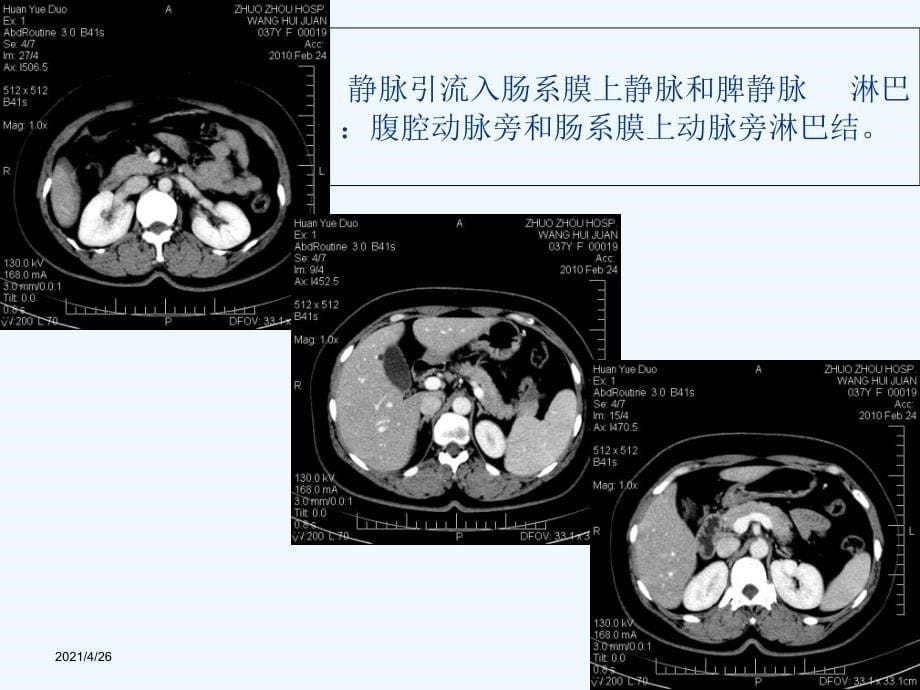 胰腺癌的影像诊断_第5页