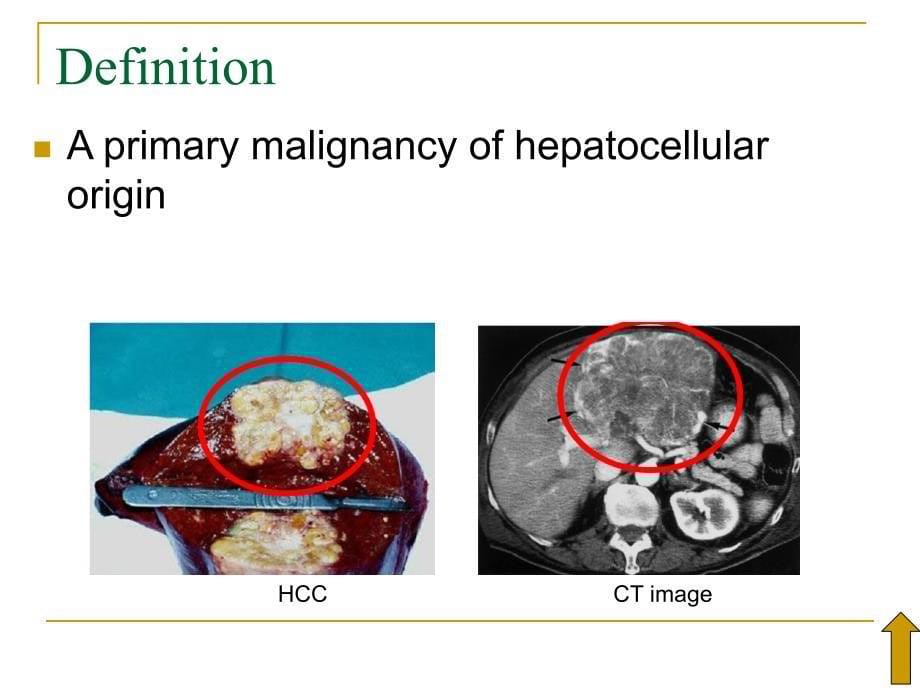 内科学：原发性肝癌 (2)_第5页