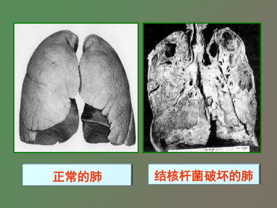 肺结核防治知识_第4页