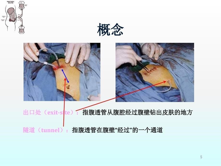 腹膜透析的护理操作ppt课件.ppt_第5页