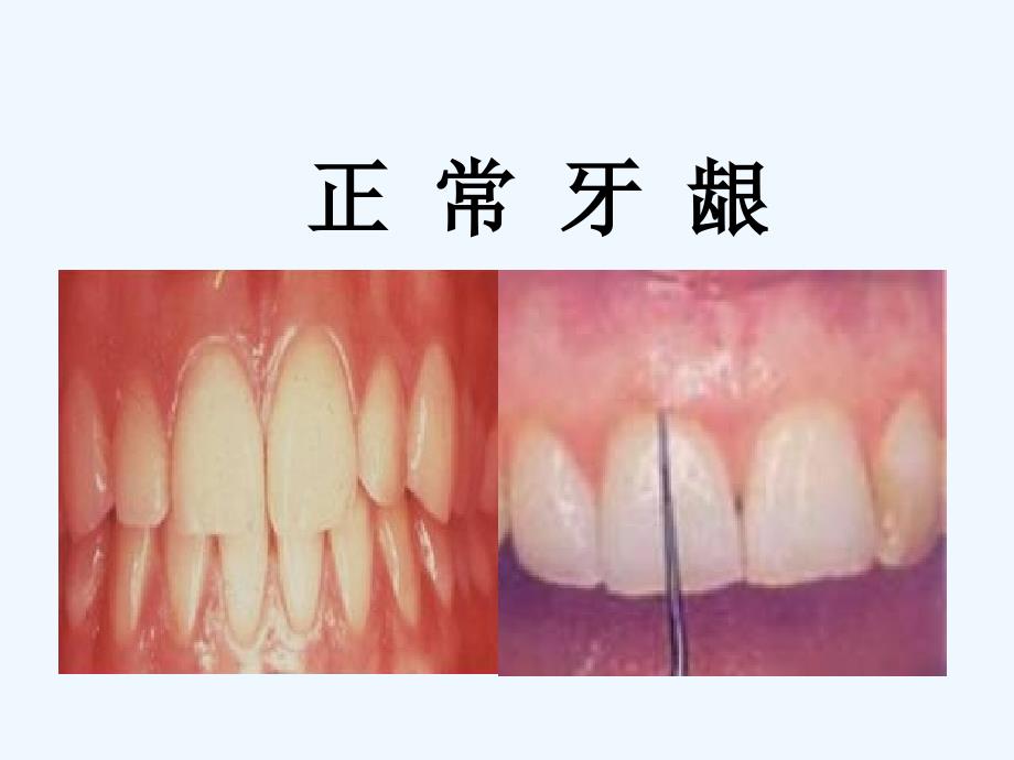 优选牙周病学牙周病的主要症状和临床病理可修改版ppt课件_第4页