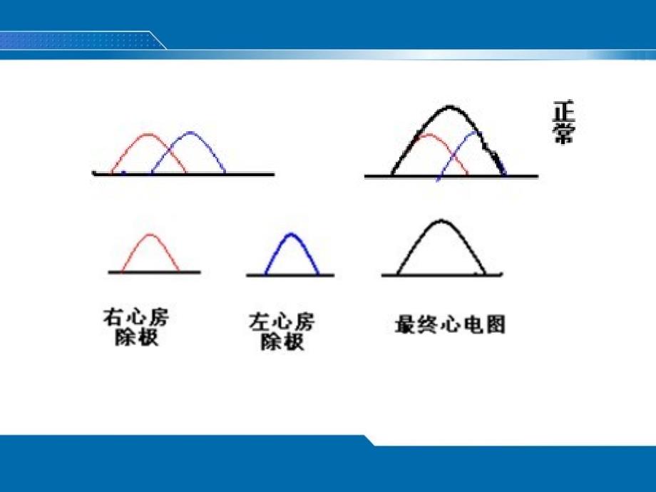 异常ECG修.ppt_第2页