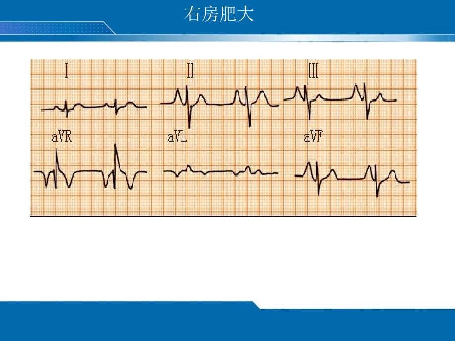 异常ECG修.ppt_第4页