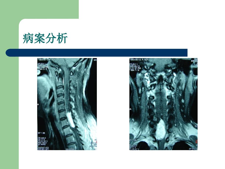 医学神经鞘瘤_第3页