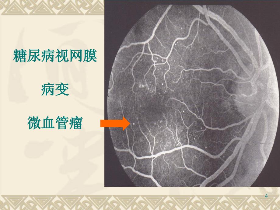 糖尿病视网膜病变的药物治疗_第4页