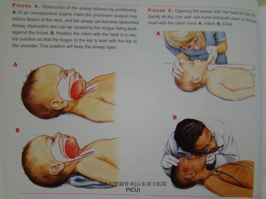 小儿气管插管术山东省立医院PICU课件_第3页