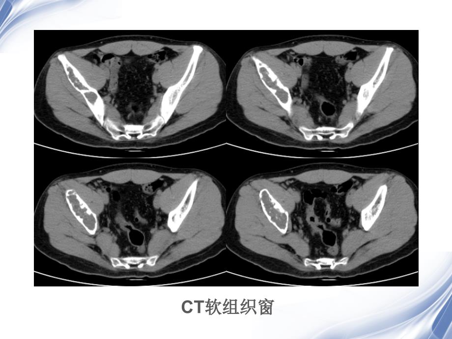 髂骨软骨粘液样纤维瘤读片.ppt_第3页