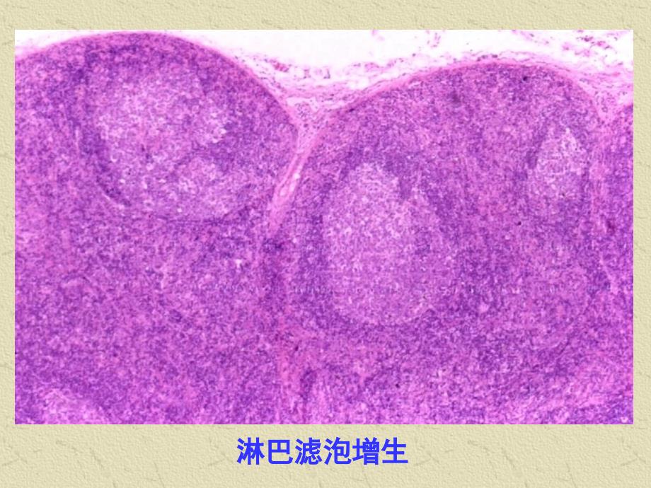 淋巴和造血系统疾病_第4页