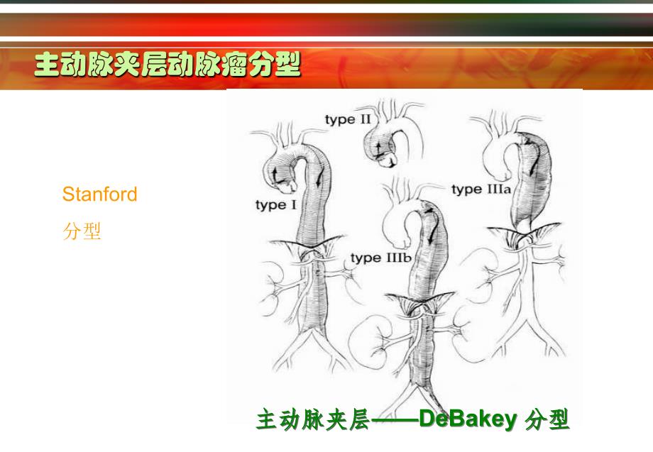 主动脉夹层动脉瘤诊断与治疗策略_第4页