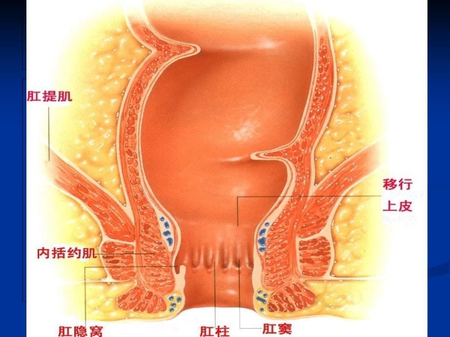 混合痔PPH与TST术试的比较_第5页