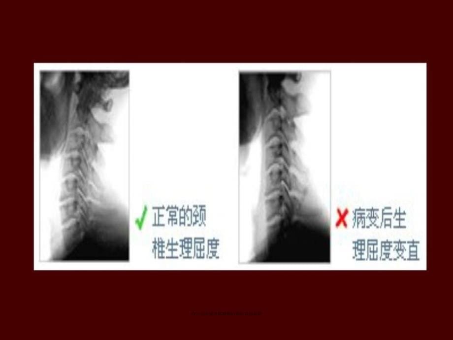 办公室保健颈椎腰椎病预防讲座范文课件_第5页