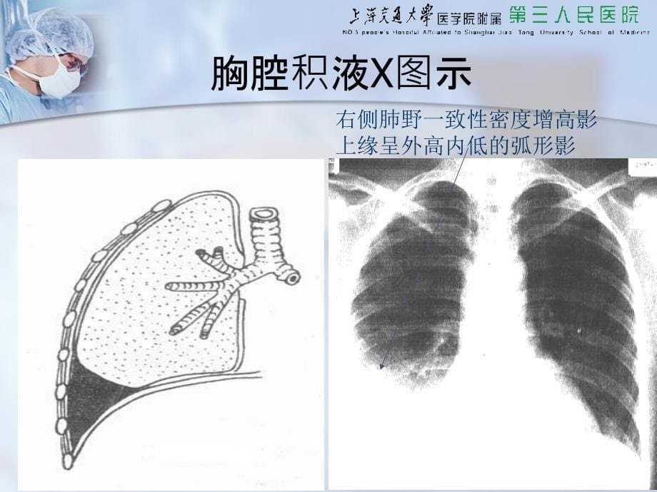 胸穿、腹穿、骨穿、腰穿四大穿刺_第5页