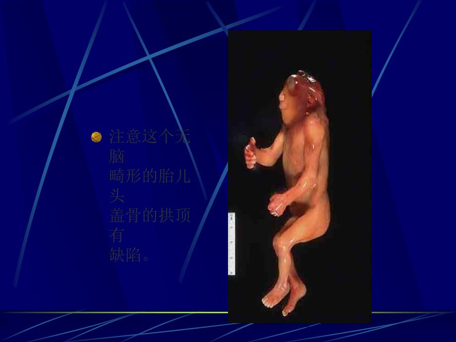 儿童营养与疾病.ppt_第4页