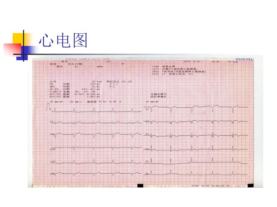 双侧桡动脉路径逆向PI例_第4页