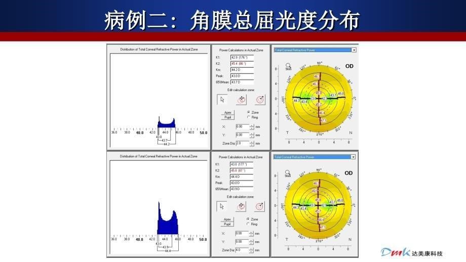 Pentacam白内障应用第二版_第5页