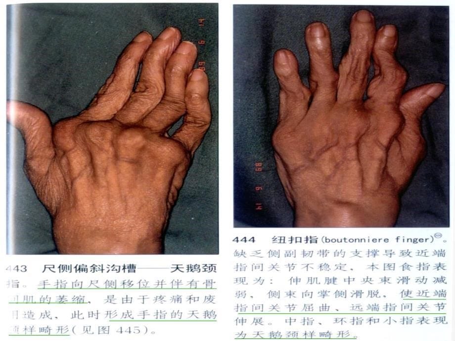 类风湿性关节炎中医治疗方案介绍_第5页