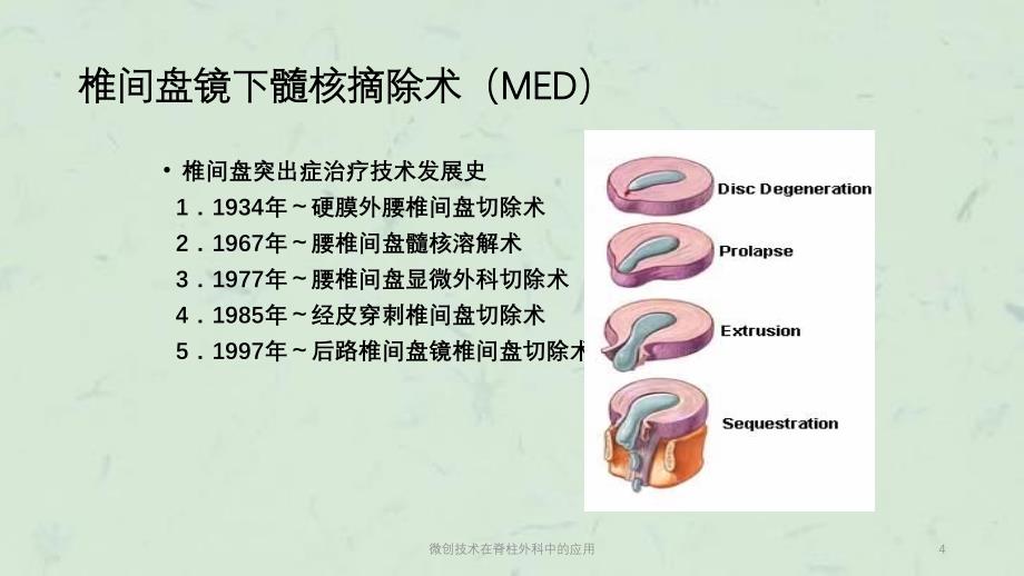 微创技术在脊柱外科中的应用课件_第4页