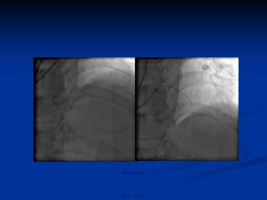 山重水复疑无路前降支慢闭塞介入治疗一例学习教案_第5页