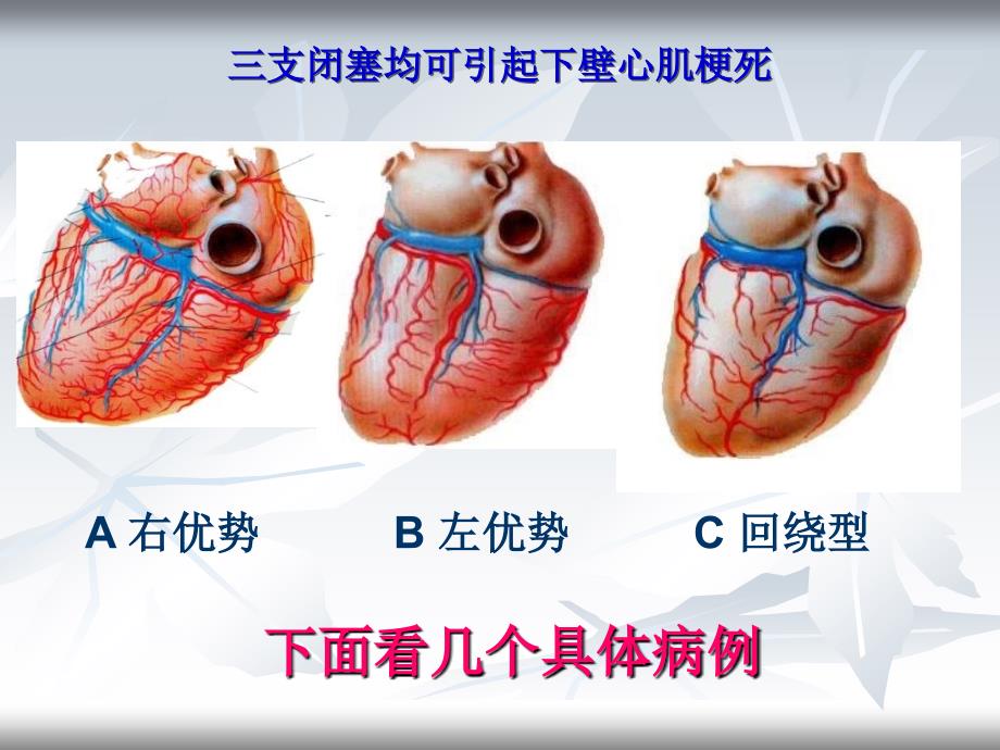 壁心肌梗死相关动脉的心电图分析_第3页