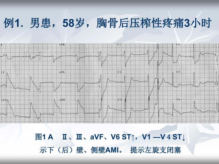 壁心肌梗死相关动脉的心电图分析_第4页