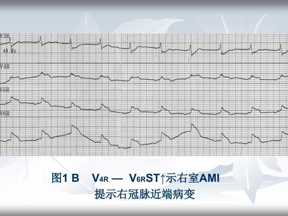 壁心肌梗死相关动脉的心电图分析_第5页