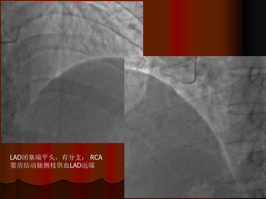 双支cto病变的pci荆全民_第4页