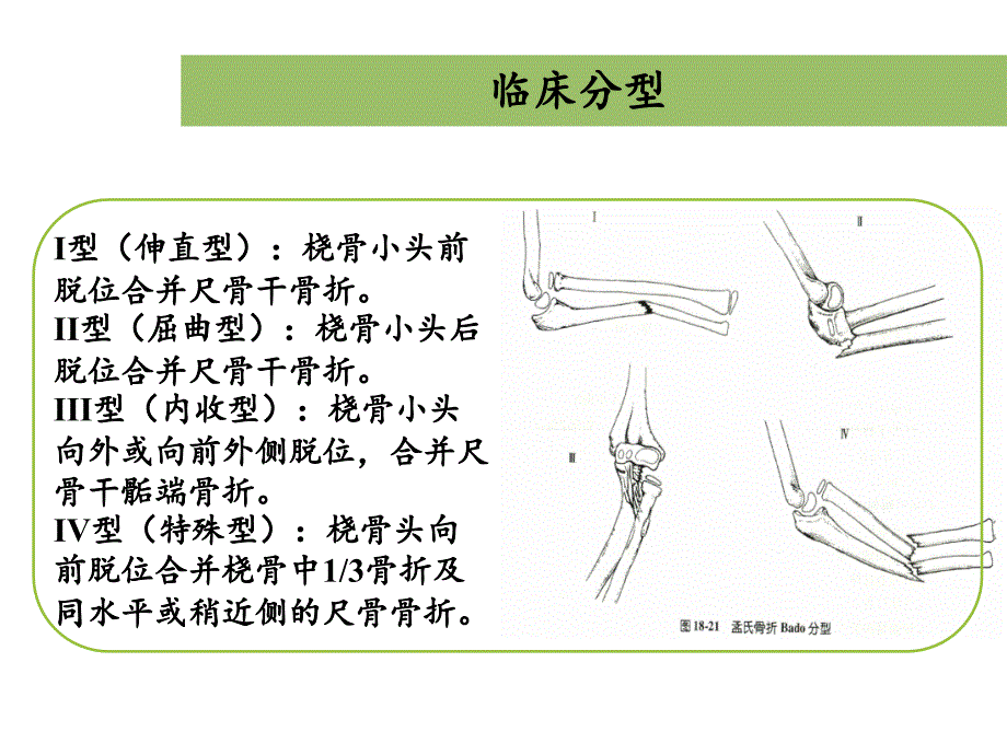 儿童孟氏骨折PPT课件_第4页