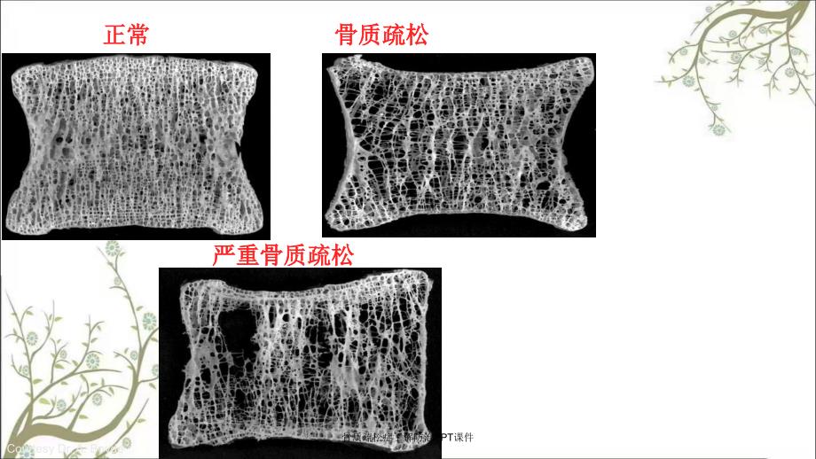 骨质疏松症了解防治PPT课件_第4页