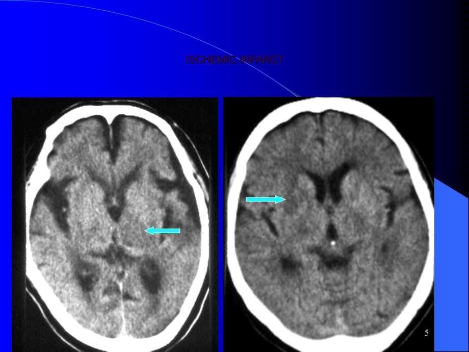 颅内非肿瘤性病变的影像学表现ppt课件_第5页
