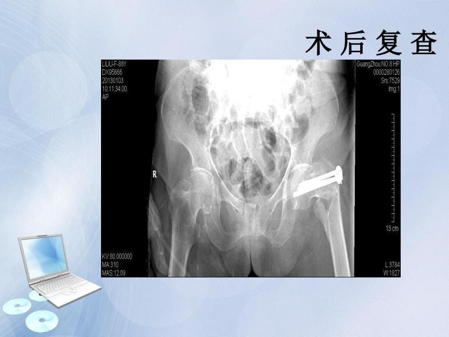 粗隆间骨折的护理查房_第5页