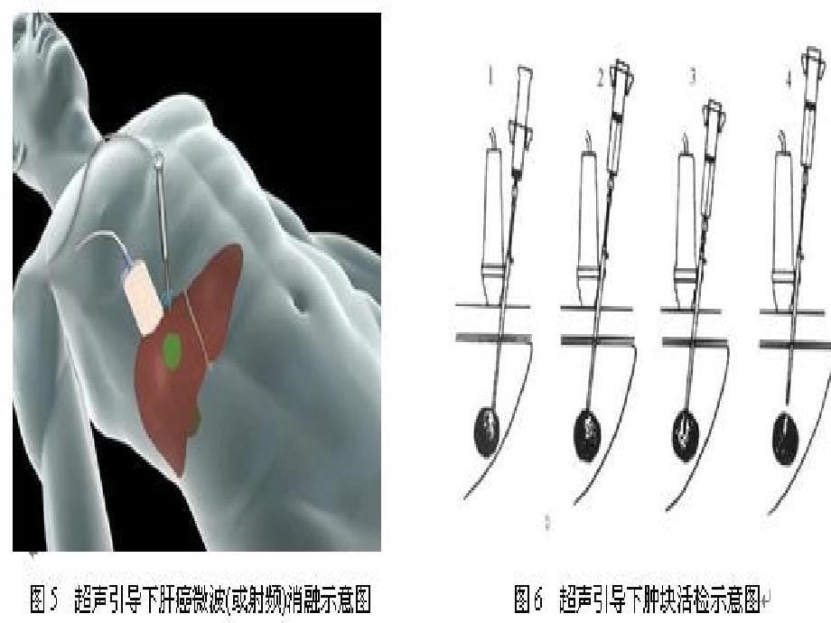 PTCD经皮肝胆管造影护理重庆第五人民医院ppt课件_第5页