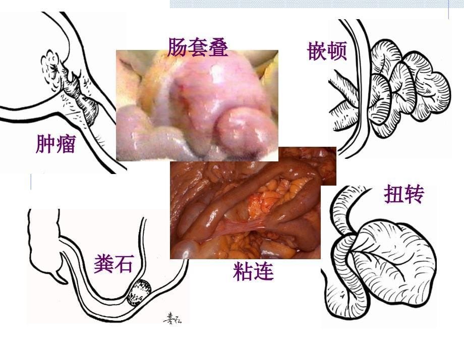 肠梗阻病人的护理-PPT_第5页