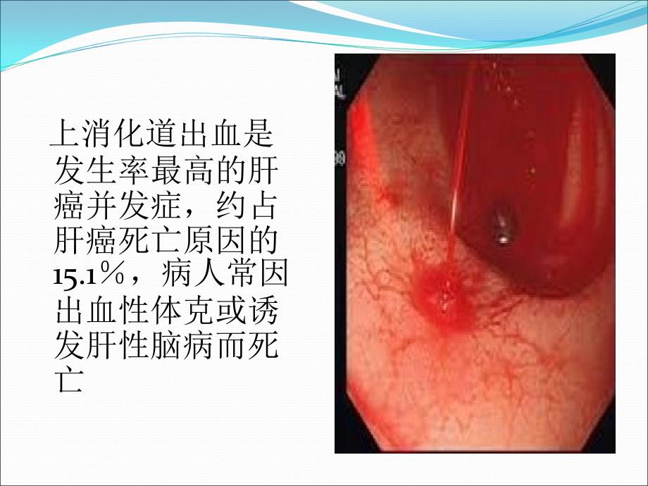 肝癌并上消化道出血的护理_第3页
