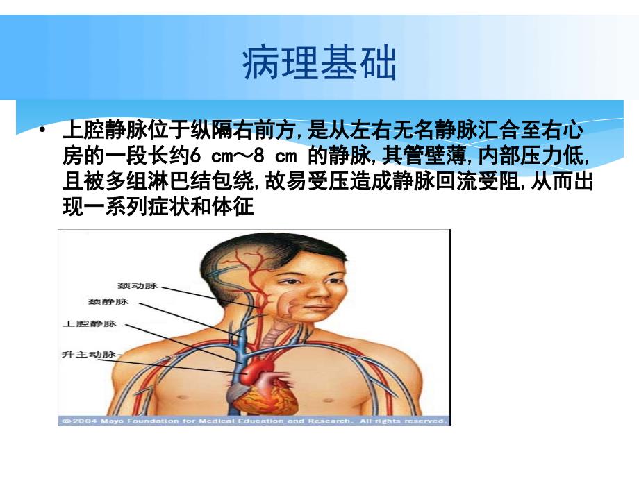 上腔静脉综合征护理_第4页