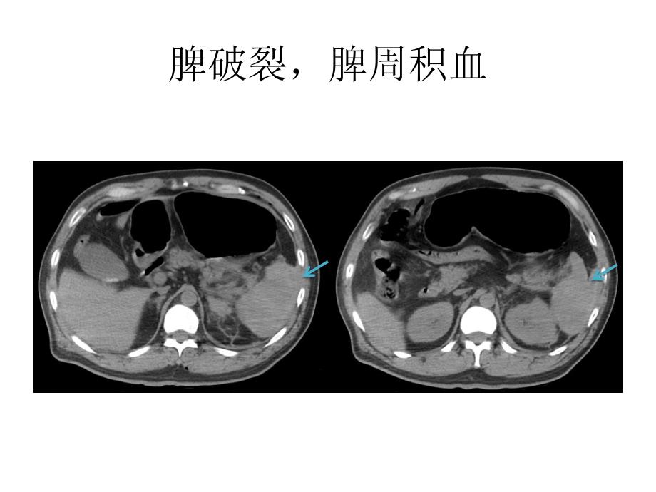 腹部实质性脏器外伤的ct表现ppt课件_第4页