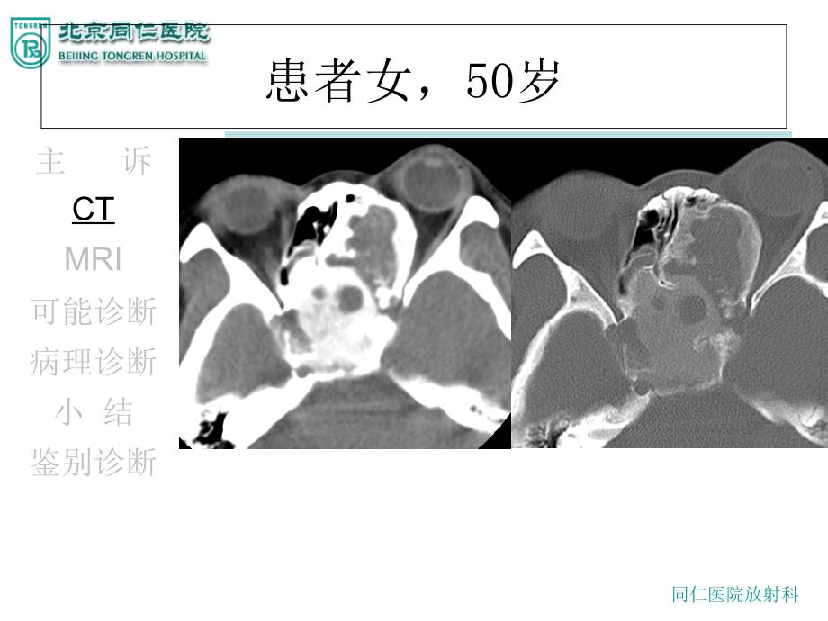 《骨化性纤维瘤》PPT课件_第3页