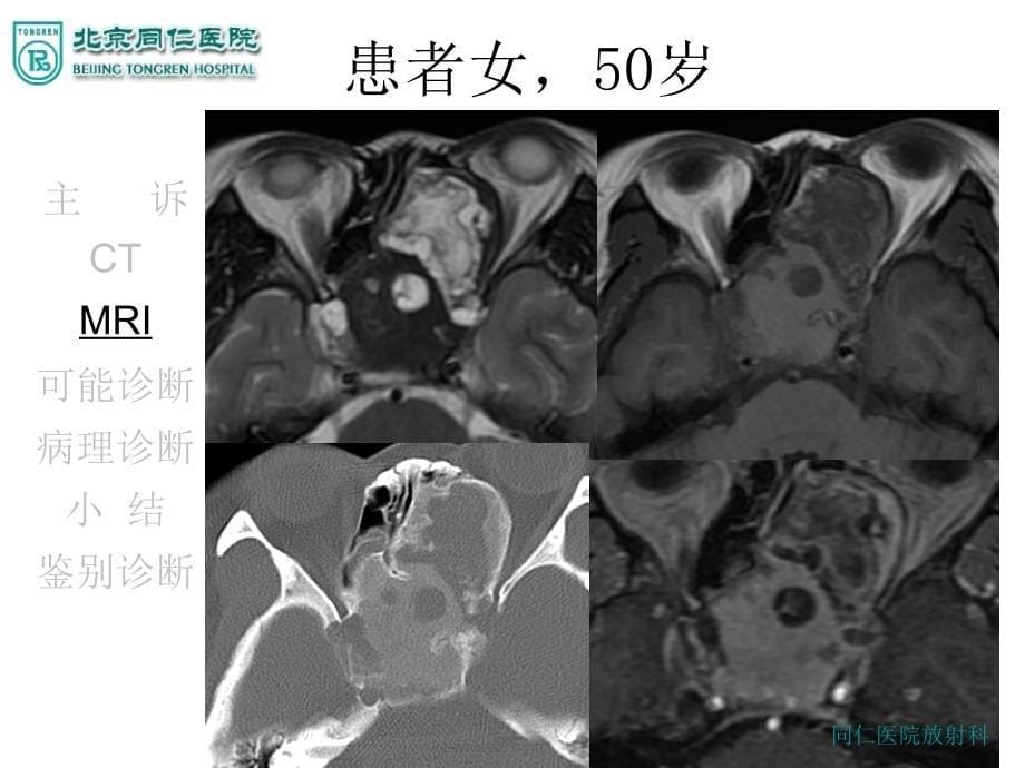 《骨化性纤维瘤》PPT课件_第5页