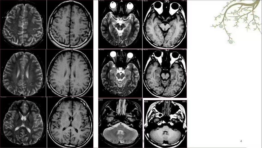 磁共振成像诊断MRI脑部疾病课件_第4页
