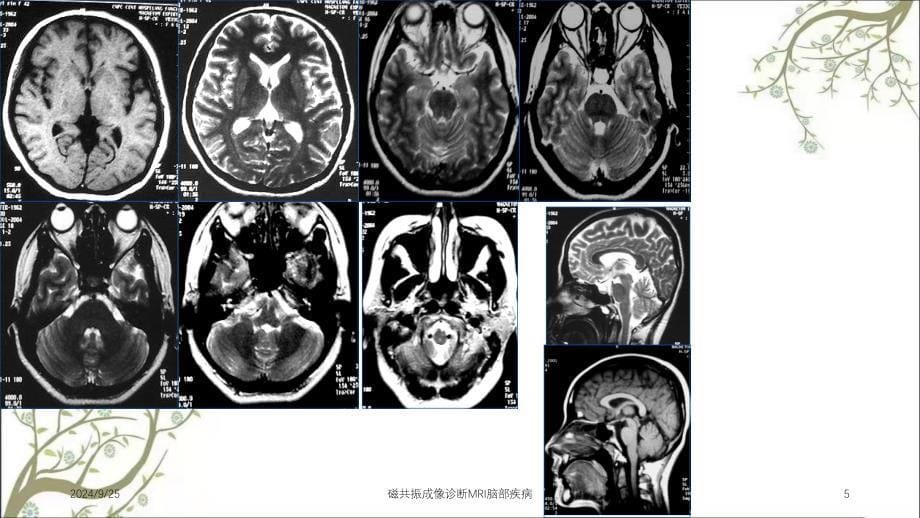 磁共振成像诊断MRI脑部疾病课件_第5页