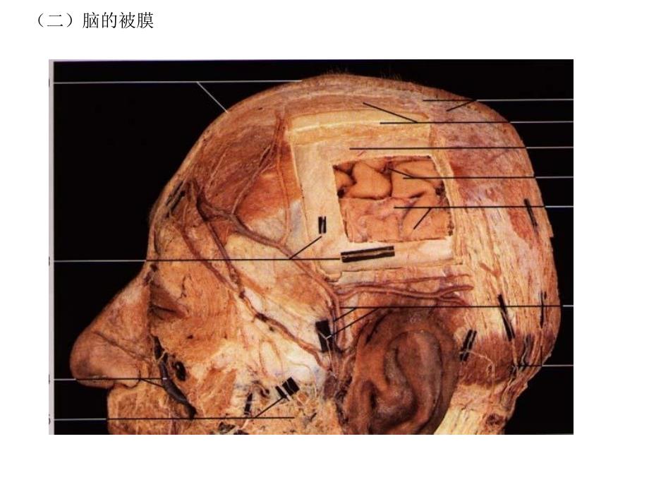 《解剖脑脊膜》PPT课件_第3页