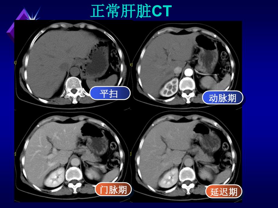 医学pptct增强扫描的临床应用_第4页